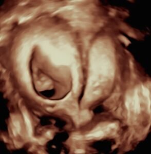 Utero Septado